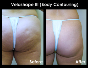 Focus Laser and Spa- Velashape for cellulite